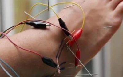 Електроакупунктура